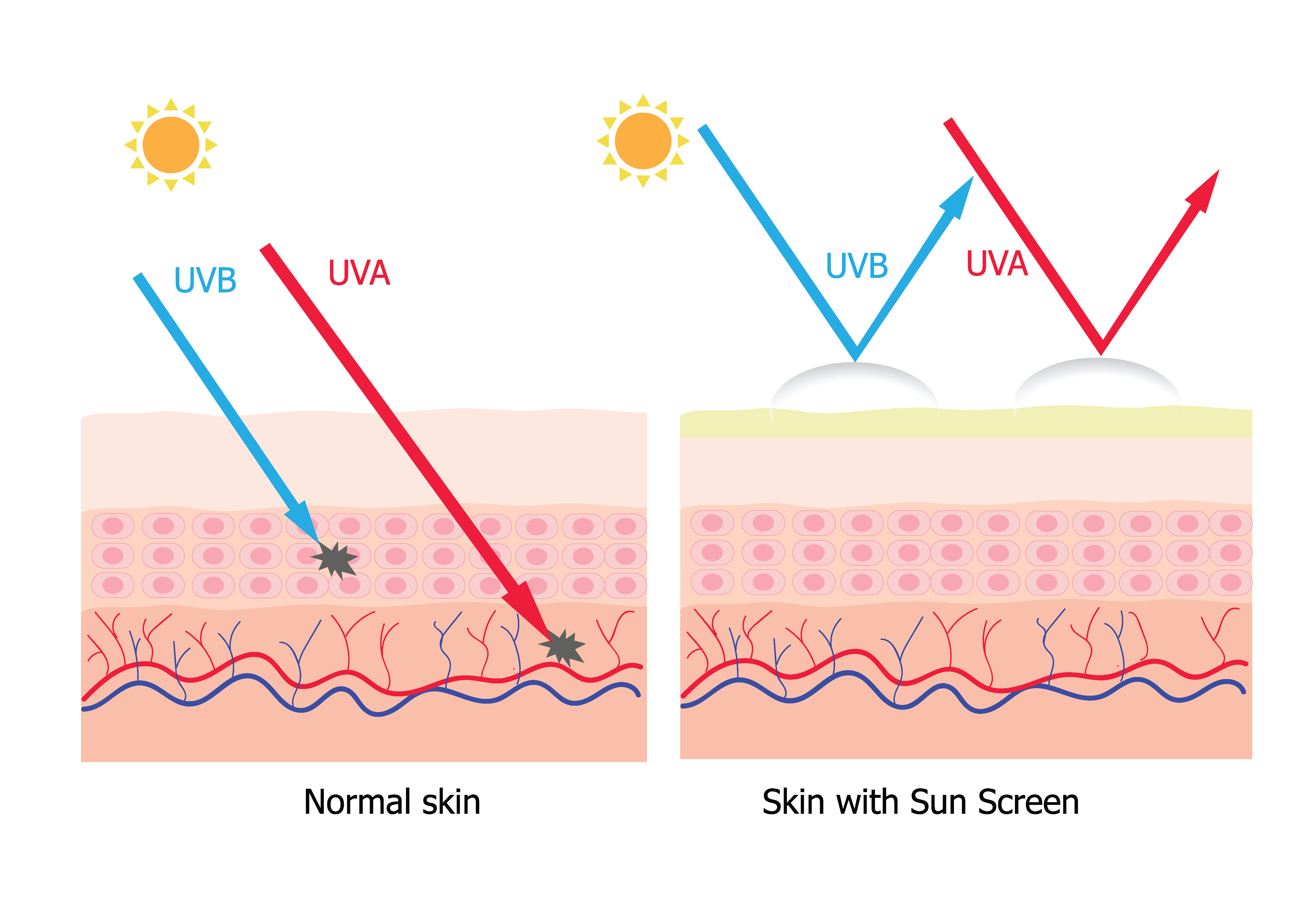 Под действием ультрафиолетовых лучей у человека появляется. Воздействие солнечных лучей на кожу человека. Воздействие УФ лучей на кожу. Защита кожи от УФ излучения. Защита кожи от ультрафиолетовых лучей.